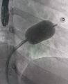 قسطرة قلبية ناجحة لمريضة باستخدام البالون العلاجي في مركز القلب بالقريات